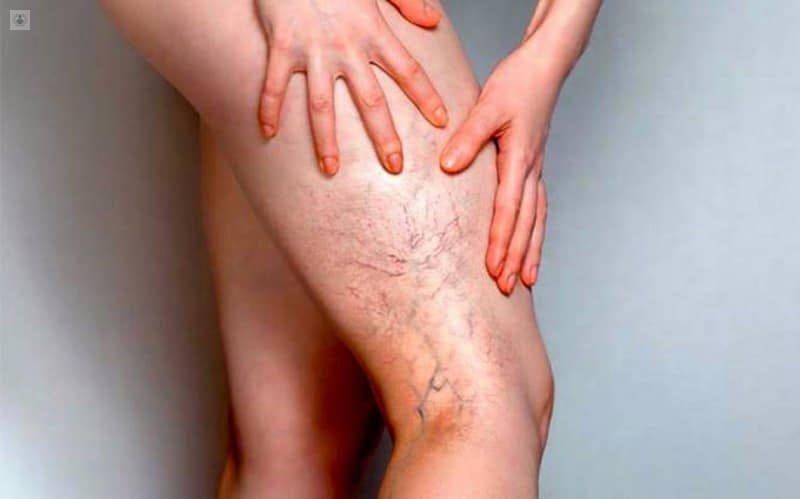 PARCHE MEDICINAL PARA VARICES - Imagen 7